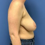 Breast Reduction Before & After Patient #1509