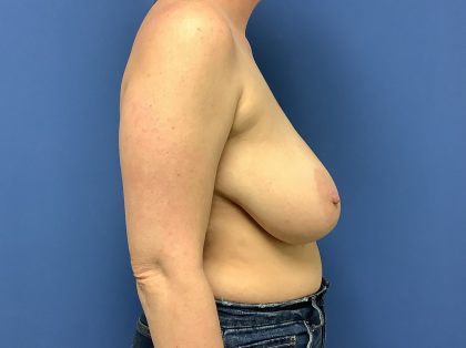 Breast Reduction Before & After Patient #1509