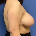 Breast Reduction Before & After Patient #1519