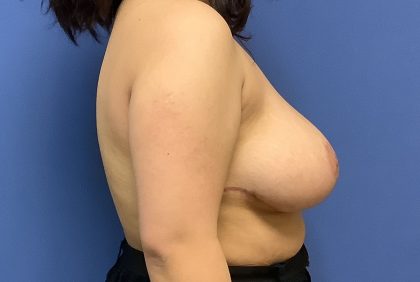 Breast Reduction Before & After Patient #1519