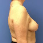Breast Reduction Before & After Patient #1524