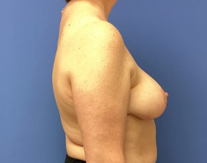 Breast Reduction Before & After Patient #1524