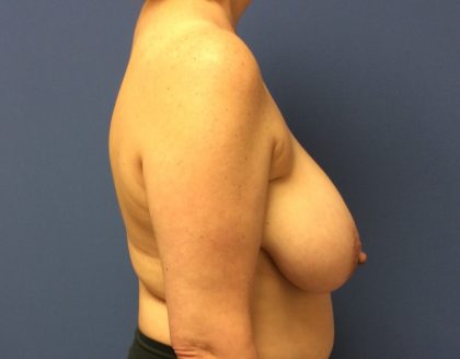 Breast Reduction Before & After Patient #1524