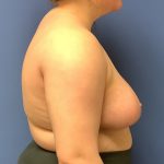 Breast Reduction Before & After Patient #1529