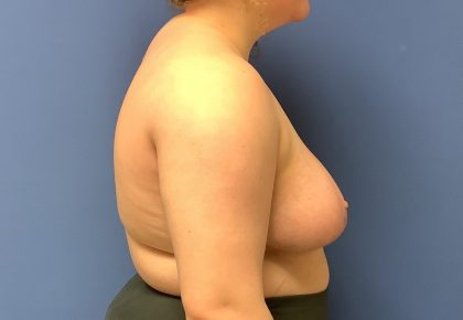 Breast Reduction Before & After Patient #1529