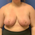 Breast Reduction Before & After Patient #1529