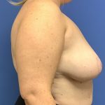 Breast Reduction Before & After Patient #1534