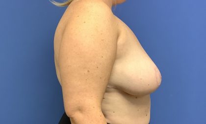 Breast Reduction Before & After Patient #1534
