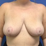 Breast Reduction Before & After Patient #1534
