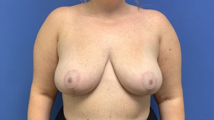 Breast Reduction Before & After Patient #1534
