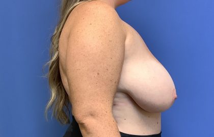 Breast Reduction Before & After Patient #1534