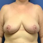 Breast Reduction Before & After Patient #1539