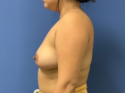 Breast Reduction Before & After Patient #1544