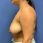 Breast Reduction Before & After Patient #1544
