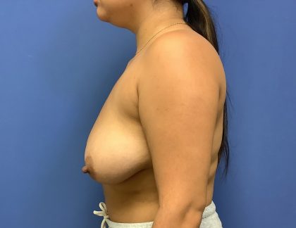 Breast Reduction Before & After Patient #1544