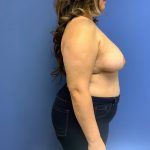 Breast Reduction Before & After Patient #1554