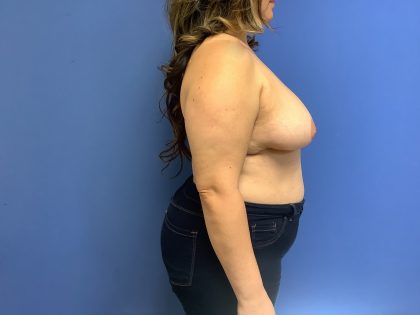 Breast Reduction Before & After Patient #1554