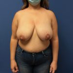 Breast Reduction Before & After Patient #1554