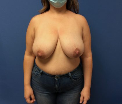 Breast Reduction Before & After Patient #1554