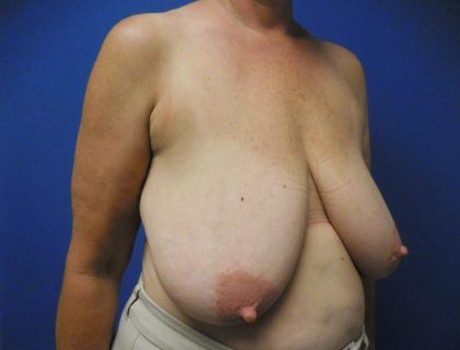 Breast Reduction Before & After Patient #1559