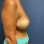 Breast Reduction Before & After Patient #1569