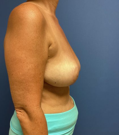 Breast Reduction Before & After Patient #1569