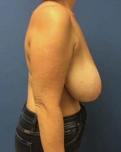 Breast Reduction Before & After Patient #1569