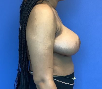 Breast Reduction Before & After Patient #1574
