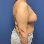 Breast Reduction Before & After Patient #1579