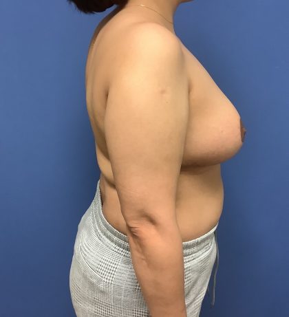 Breast Reduction Before & After Patient #1579