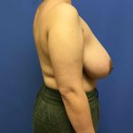 Breast Reduction Before & After Patient #1579