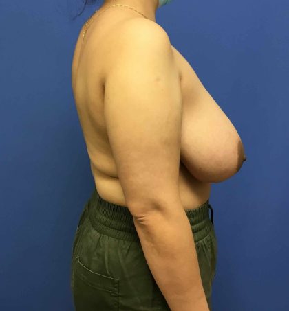 Breast Reduction Before & After Patient #1579