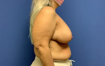 Breast Reduction Before & After Patient #1594