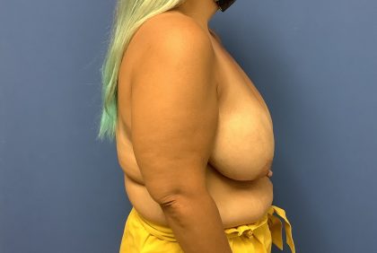 Breast Reduction Before & After Patient #1594