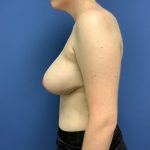 Breast Reduction Before & After Patient #1599