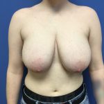 Breast Reduction Before & After Patient #1599