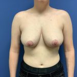 Breast Reduction Before & After Patient #1599