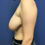 Breast Reduction Before & After Patient #1599