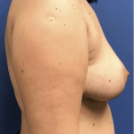 Breast Reduction Before & After Patient #1604