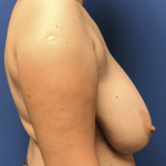 Breast Reduction Before & After Patient #1604