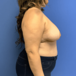 Breast Reduction Before & After Patient #1614
