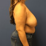 Breast Reduction Before & After Patient #1614