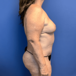 Breast Reduction Before & After Patient #1619