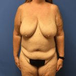 Breast Reduction Before & After Patient #1619
