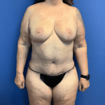 Breast Reduction Before & After Patient #1619