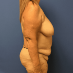 Breast Reduction Before & After Patient #1619