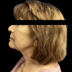 Facelift Before & After Patient #1636