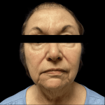 Facelift Before & After Patient #1636