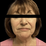Facelift Before & After Patient #1636