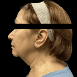 Facelift Before & After Patient #1636